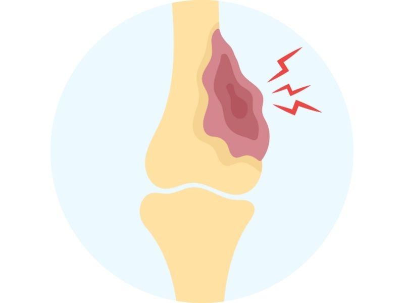 cocuklarda-gorulen-kemik-cikintilari